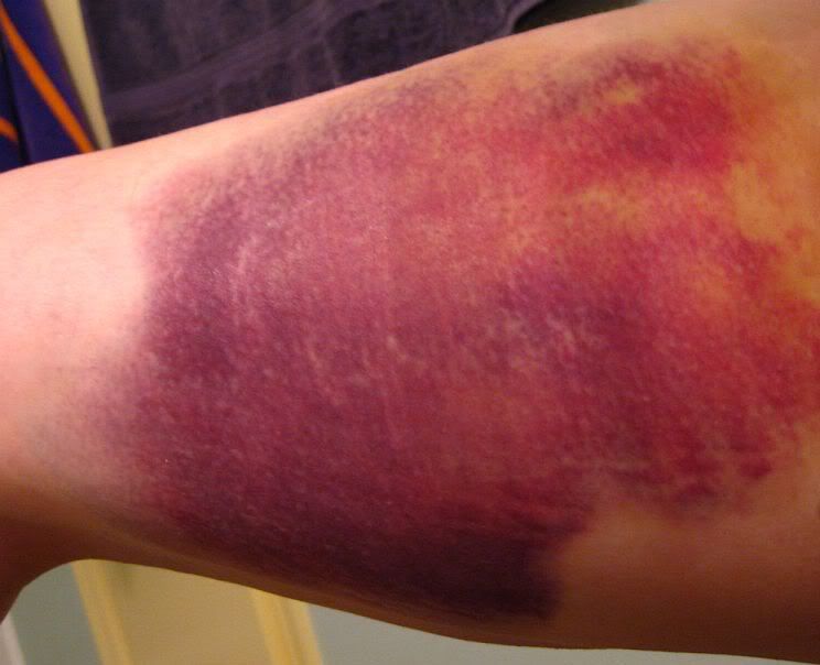Bruise Color Progression