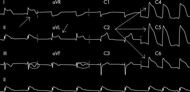tombstones on ekg. Tar - ECG clinic : Tombstone