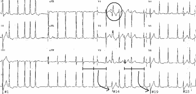 Atrial Fibrillation Ekg. Atrial Fibrillation with RVR